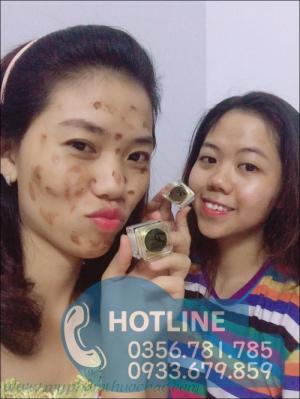 Cao thuốc bắc chuyên gia điều trị dị ứng da
