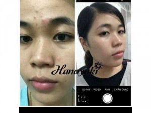 Hana Acnes