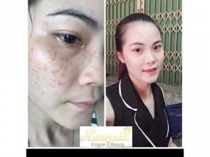 Hana Melasma Trị Nám, tàn nhang