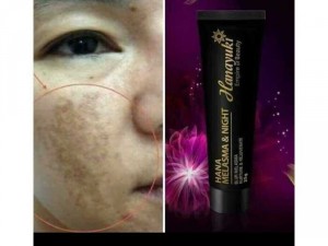 Hana Melasma Trị Nám, tàn nhang