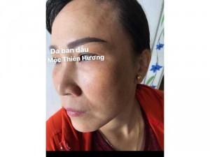 Mỹ phẩm trị nám