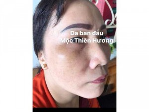 Mỹ phẩm trị nám