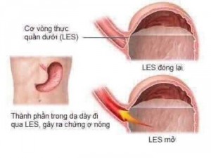 Sản phẩm giúp đặc trị dạ dày viêm loét dạ dày tá tràng khó tiêu.