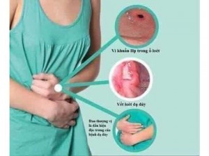 Sản phẩm giúp đặc trị dạ dày viêm loét dạ dày tá tràng khó tiêu.