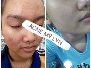 Kem trị mịn acne