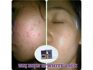 Trị Mụn M'White