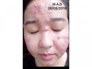 MAD sạch mụn tái tạo da