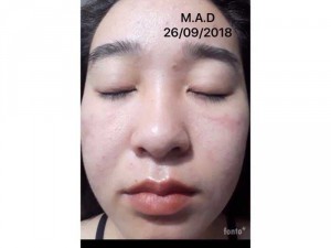 MAD sạch mụn tái tạo da