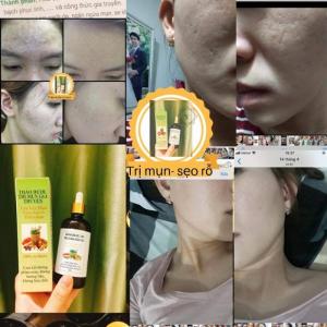 Trị mụn thảo dược