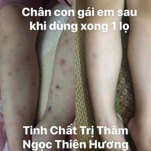 Tinh dầu trị thâm Ngọc Thiên Hương.