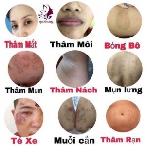 Tinh dầu trị thâm Ngọc Thiên Hương.