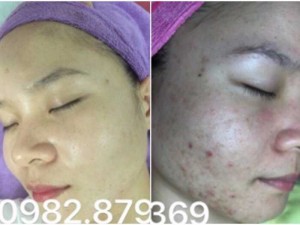 Kem Pháp LANCOMAI SỈ mỹ phẩm kem dưỡng da mặt, dưỡng ẩm trị mụn
