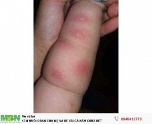 Kem Muỗi Oran Cho Mẹ Và Bé Xài Cả Năm Chưa Hết