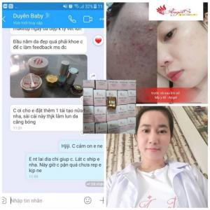 Kem liền sẹo Angel