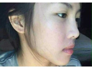 Thanh dược siêu trị tất cả các loại mụn
