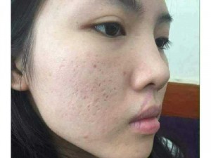 Thanh dược siêu trị tất cả các loại mụn