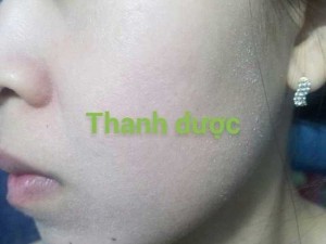 Mỹ phẩm Thanh dược đặc trị tàn nhang