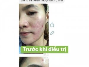 Trị mụn