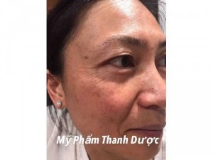 Mỹ phẩm Thanh dược đặc trị nám
