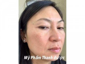 Mỹ phẩm Thanh dược đặc trị nám