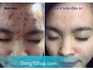 Kem trị mụn dưỡng da hoa đào Đông y