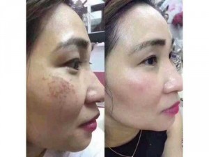 Kem trị nám tàn nhang hoa đào