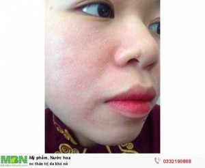 Trị da khô nẻ