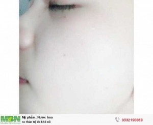 Trị da khô nẻ