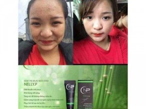 Trị mụn nelly.P