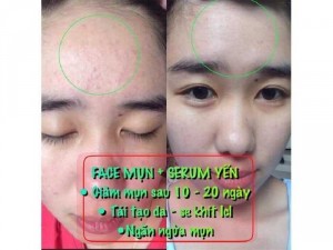 COMBO TRỊ MỤN SICA WHITE