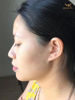Gel trị mụn