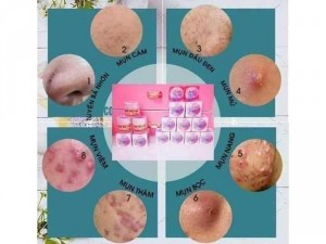 Kem đặc trị mụn acne
