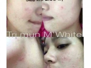 Trị mụn M'White