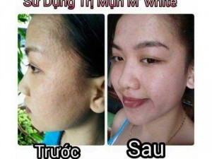 Trị mụn M'White