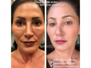Kem Tretinoin 0.05% Retin A 0.05% Vitacid 0.05%