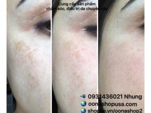 Hydroquinone 5% (Mediquin 5%)