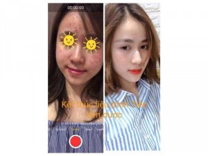Đặc trị mụn thâm nám tàn nhang - cam kết ko hết hoàn tiền 100%