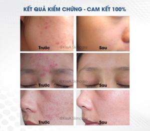 Kem Hỗ Trợ Điều Trị Mụn KissA