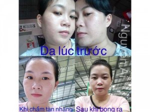 Chấm Tàn Nhang & Nốt Ruồi Cao 7 Ngày Bong, Không Để Lại Sẹo