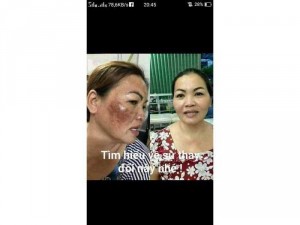 Bong Nám 3 Ngày Bong (Trị Được Rỗ )