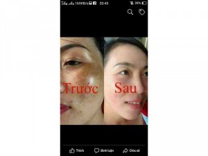 Bong Nám 3 Ngày Bong (Trị Được Rỗ )