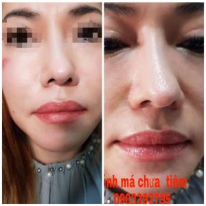 Căng da mặt bằng chỉ ở đâu tốt nhất