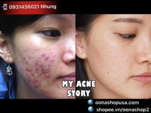 Kem Retin A 0.05% (Tretinoin 0.05%)- Kem Vitacid Retinoic Acid 0.05%