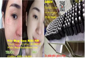 thuốc trị nám tìm đối tác KD