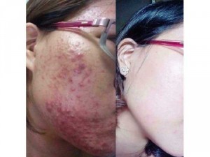 Sắc dược trị mụn nám
