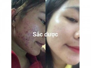 Sắc dược trị mụn nám