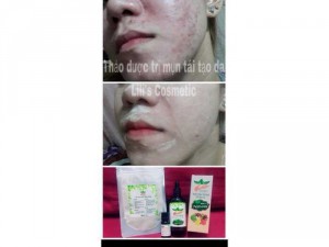 Sản phẩm trị mụn tái tạo da Lili’s Cosmetic