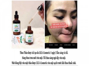 Sản phẩm trị mụn tái tạo da Lili’s Cosmetic