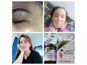 Cô Gái Núi trị nám, tàn nhang