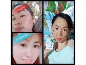 Cô Gái Núi trị nám, tàn nhang